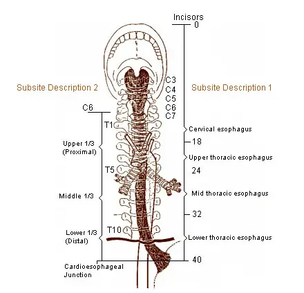 Constricted Esophagus