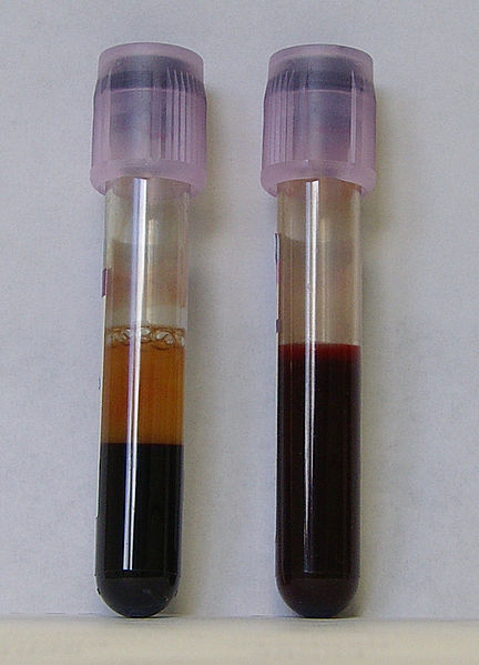 EDTA-anticoagulated blood